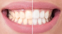 Bleaching -