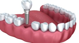 Implantat -