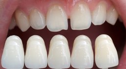 Veneers -