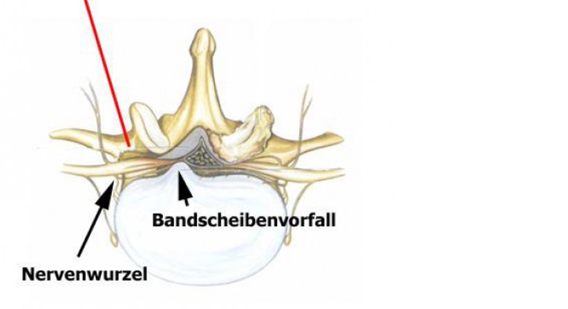 Infiltrationen der Wirbelsäule und Nerven im Röntgen oder CT-gesteuert - OA Dr. med. Nazem Atassi - Neurochirurg Wien 1190