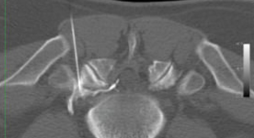 Infiltrationen der Wirbelsäule und Nerven im Röntgen oder CT-gesteuert - OA Dr. med. Nazem Atassi - Neurochirurg Wien 1190
