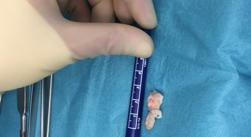 Minimalinvasive endoskopische Bandscheibenchirurgie - OA Dr. med. Nazem Atassi - Neurochirurg Wien 1190