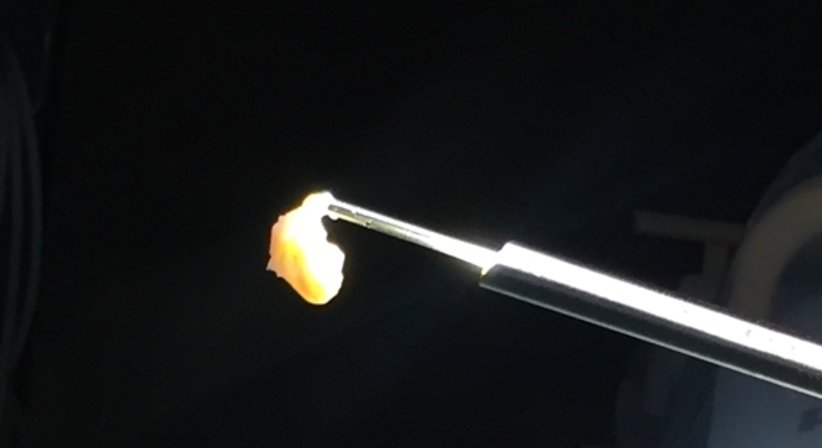 Minimalinvasive endoskopische Bandscheibenchirurgie - OA Dr. med. Nazem Atassi - Neurochirurg Wien 1190