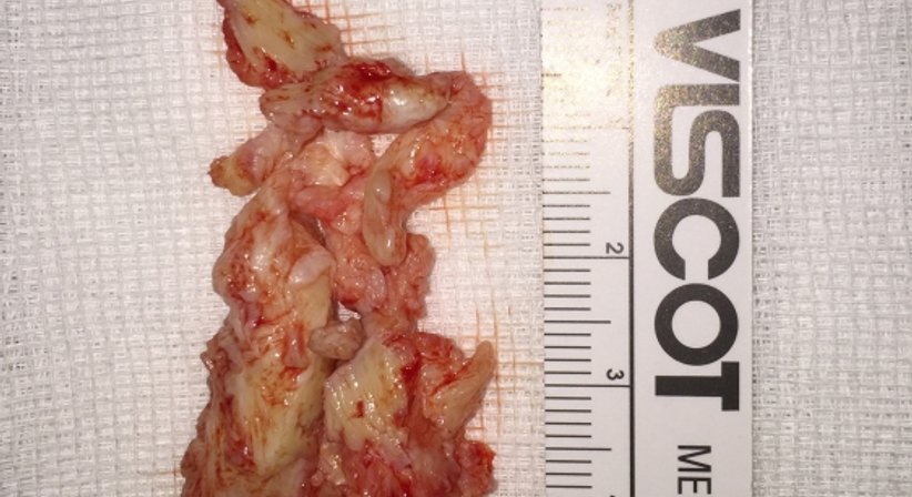 Operationen bei degenerativen Erkrankungen der gesamten Wirbelsäule  - OA Dr. med. Nazem Atassi - Neurochirurg Wien 1190