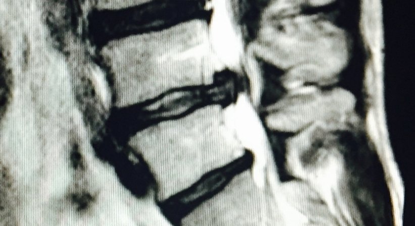 Operationen bei degenerativen Erkrankungen der gesamten Wirbelsäule  - OA Dr. med. Nazem Atassi - Neurochirurg Wien 1190