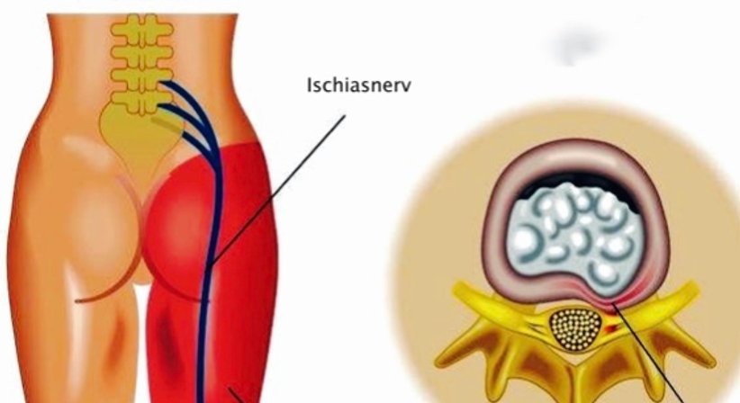 Operationen bei degenerativen Erkrankungen der gesamten Wirbelsäule  - OA Dr. med. Nazem Atassi - Neurochirurg Wien 1190