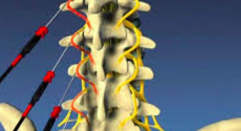 Thermokoagulation bei chronischen Rückenschmerzen - OA Dr. med. Nazem Atassi - Neurochirurg Wien 1190