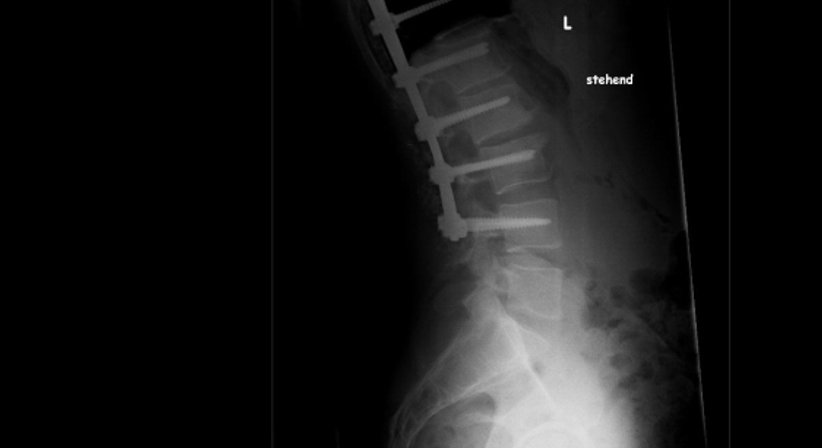 Wirbelkörperfrakturen (Kyphoplastie, stabilisierende Verfahren) - OA Dr. med. Nazem Atassi - Neurochirurg Wien 1190