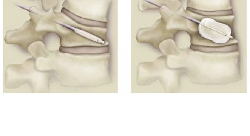 Wirbelkörperfrakturen (Kyphoplastie, stabilisierende Verfahren) - OA Dr. med. Nazem Atassi - Neurochirurg Wien 1190