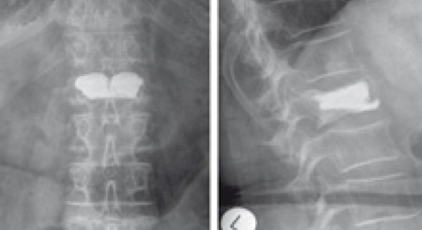 Wirbelkörperfrakturen (Kyphoplastie, stabilisierende Verfahren) - OA Dr. med. Nazem Atassi - Neurochirurg Wien 1190