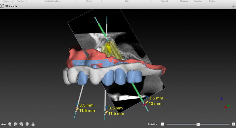Computergestützte Implantologie - Dr. Thomas Pawlowski - Zahnarzt Wien 1010