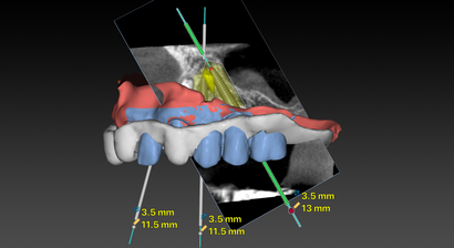 Computernavigierte Implantologie