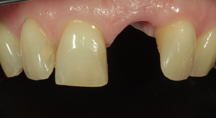 Folgen von Zahnverlust - Dr. Thomas Pawlowski - Zahnarzt Wien 1010