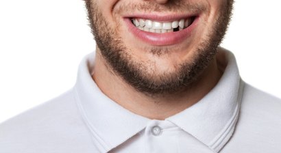 Ursachen von Zahnverlust