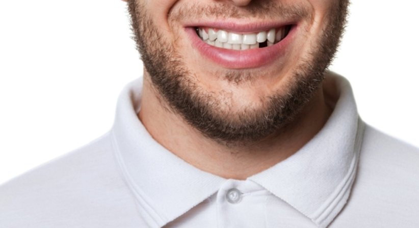 Ursachen von Zahnverlust - Dr. Thomas Pawlowski - Zahnarzt Wien 1010