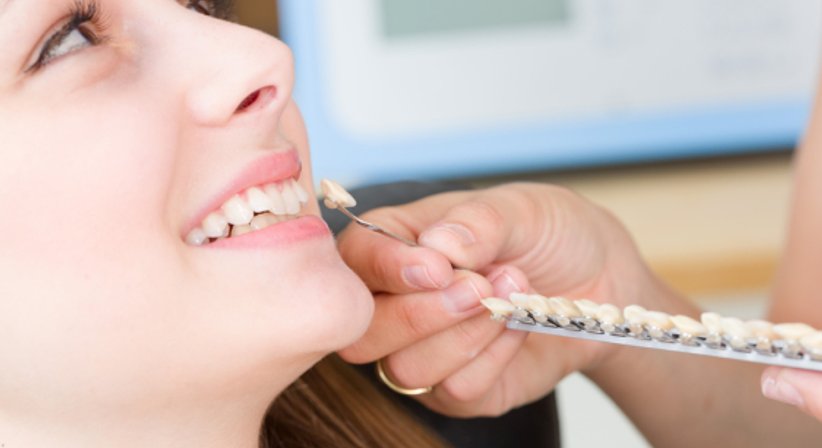 Veneers (Micro Veneers) - Dr. Thomas Pawlowski - Zahnarzt Wien 1010