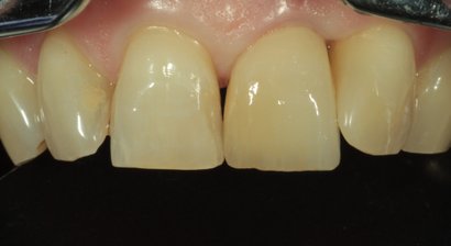 Vorteile von Implantaten