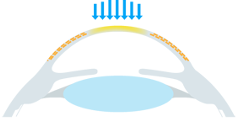 Crosslinking (CXL) - Augen OP - Dr. Victor Derhartunian, FEBO - Augenarzt Wien 1010