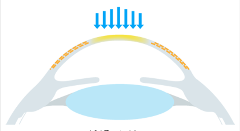 Crosslinking (CXL) - Augen OP - Dr. Victor Derhartunian, FEBO - Augenarzt Wien 1010
