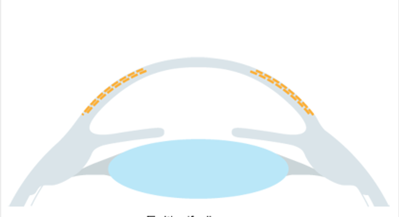 Epi-LASIK / LASEK / PRK / no-touch-PRK - Augenlaser Behandlung - Dr. Victor Derhartunian, FEBO - Augenarzt Wien 1010