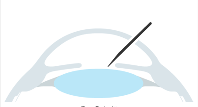 Phake Linsen - Augen OP - Dr. Victor Derhartunian, FEBO - Augenarzt Wien 1010