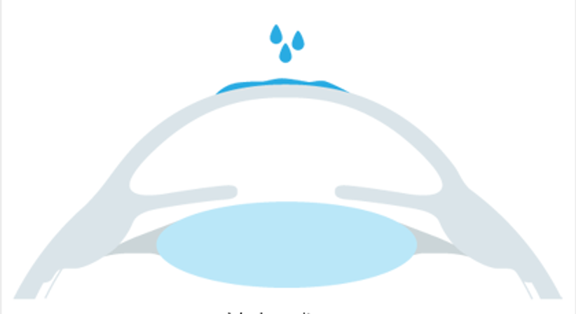 Phake Linsen - Augen OP - Dr. Victor Derhartunian, FEBO - Augenarzt Wien 1010