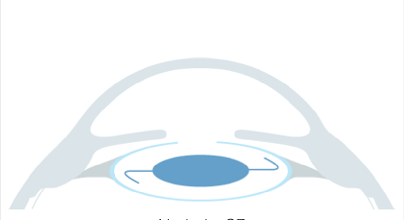 RLA - Refraktiver Linsenaustausch - Augen OP - Dr. Victor Derhartunian, FEBO - Augenarzt Wien 1010