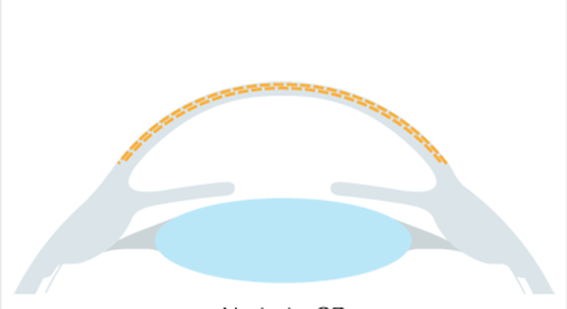 Crosslinking (CXL) - Augen OP - Dr. Victor Derhartunian, FEBO - Augenarzt Wien 1010