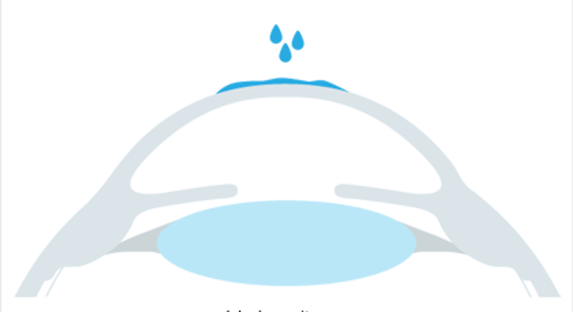 RLA - Refraktiver Linsenaustausch - Augen OP - Dr. Victor Derhartunian, FEBO - Augenarzt Wien 1010