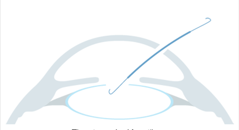 RLA - Refraktiver Linsenaustausch - Augen OP - Dr. Victor Derhartunian, FEBO - Augenarzt Wien 1010