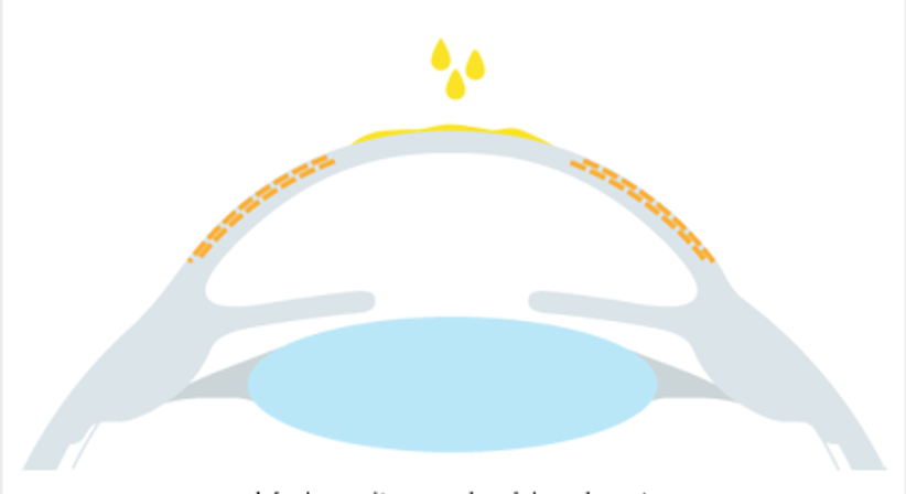 Crosslinking (CXL) - Augen OP - Dr. Victor Derhartunian, FEBO - Augenarzt Wien 1010