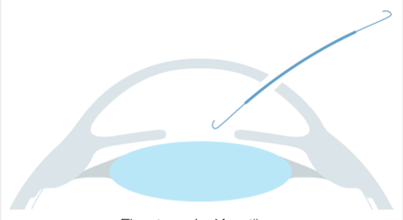 Phake Linsen - Augen OP - Dr. Victor Derhartunian, FEBO - Augenarzt Wien 1010