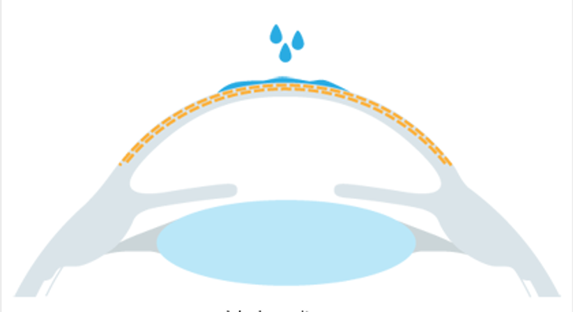 Crosslinking (CXL) - Augen OP - Dr. Victor Derhartunian, FEBO - Augenarzt Wien 1010