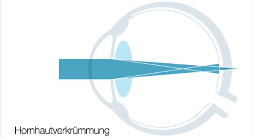 Auge: Kurzsichtigkeit, Weitsichtigkeit, Hornhautverkrümmung - Dr. Victor Derhartunian, FEBO - Augenarzt Wien 1010