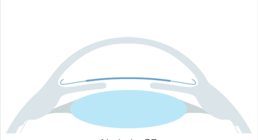 Phake Linsen - Augen OP - Dr. Victor Derhartunian, FEBO - Augenarzt Wien 1010