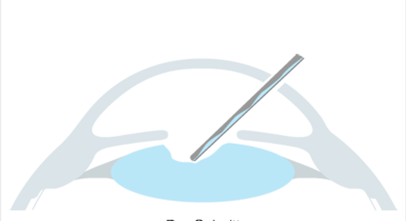 RLA - Refraktiver Linsenaustausch - Augen OP - Dr. Victor Derhartunian, FEBO - Augenarzt Wien 1010