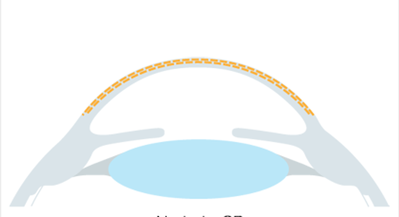 Epi-LASIK / LASEK / PRK / no-touch-PRK - Augenlaser Behandlung - Dr. Victor Derhartunian, FEBO - Augenarzt Wien 1010