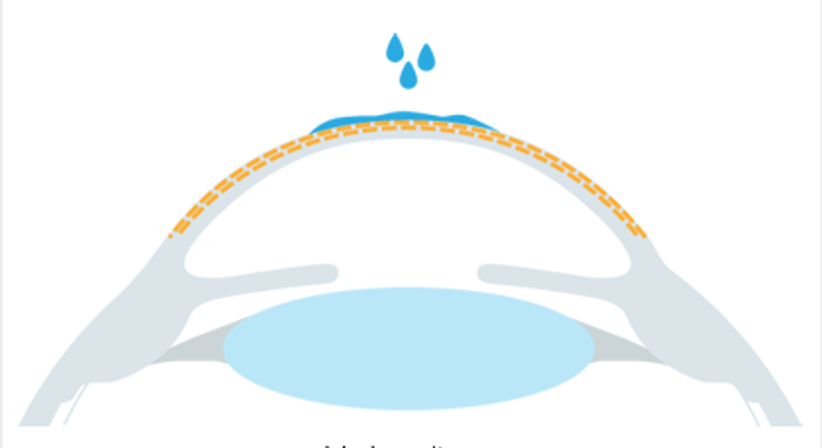 Epi-LASIK / LASEK / PRK / no-touch-PRK - Augenlaser Behandlung - Dr. Victor Derhartunian, FEBO - Augenarzt Wien 1010