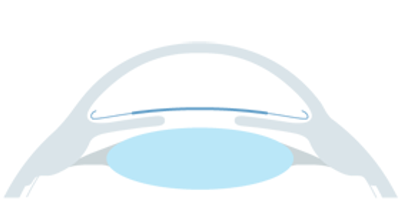 Phake Linsen - Augen OP - Dr. Victor Derhartunian, FEBO - Augenarzt Wien 1010