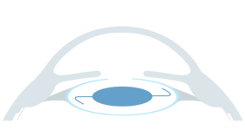 RLA - Refraktiver Linsenaustausch - Augen OP - Dr. Victor Derhartunian, FEBO - Augenarzt Wien 1010