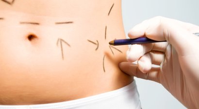 Bauchdeckenstraffung