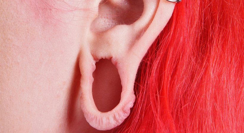 Ohrläppchenkorrektur - Dr. Ingo Plötzeneder - Plastischer Chirurg Dornbirn 6850