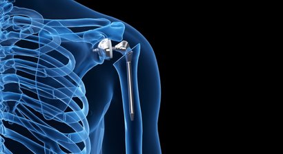 Schulterprothese (Künstliches Schultergelenk)