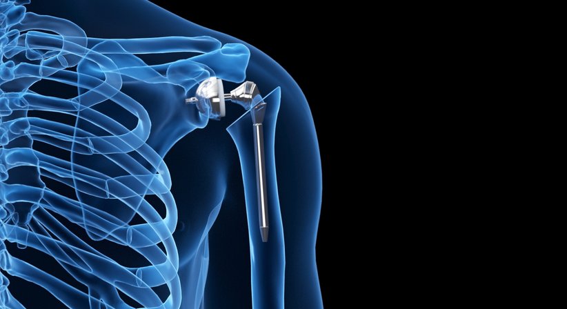Schulterprothese (Künstliches Schultergelenk) - Prim. Dr. Thomas Hofstädter - Orthopäde Salzburg 5020