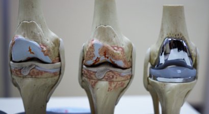 Knieprothese (Künstliches Kniegelenk)