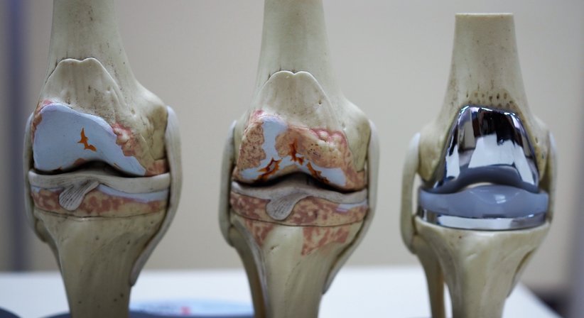 Knieprothese (Künstliches Kniegelenk) - Prim. Dr. Thomas Hofstädter - Orthopäde Salzburg 5020