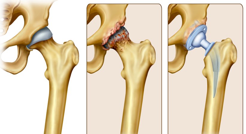 Hüfttotalendoprothese (Hüft-TEP, künstliches Hüftgelenk) - Prim. Dr. Thomas Hofstädter - Orthopäde Salzburg 5020