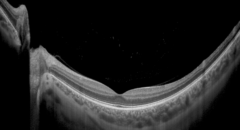 Vollständige Augenuntersuchung und Brillenbestimmung - Dr. Christoph Singer, FEBO FEBOS-R - Augenarzt Lienz 9900