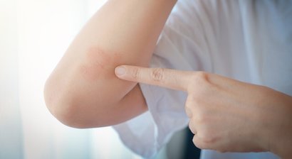 Autoimmunerkrankungen & Kollagenosen