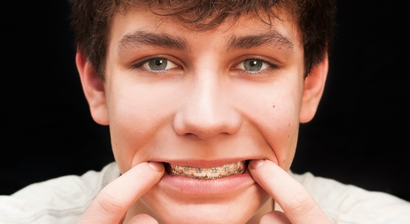 Festsitzende Zahnspange